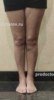 Коррекция формы ног и увеличение роста